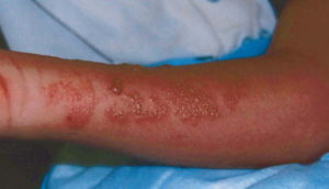 A typical jellyfish sting reaction